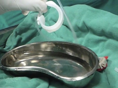 Laparoskopische Magenband OP