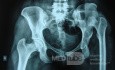 Vernachlässigte Hüftdysplasie der linken Hüfte