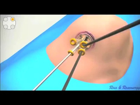 Der Weg der Cholezystektomie: von den Anfängen bis hin zur LESS (Laparo-endoskopische Einzelschnitt-Cholezystektomie).