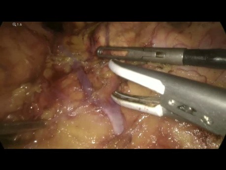 Adrenalektomie links – laparoskopischer Ansatz