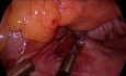 vNOTES: Die Operative Behandlung des Uterusprolapses