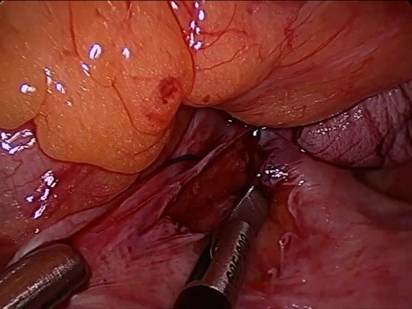 vNOTES: Die Operative Behandlung des Uterusprolapses