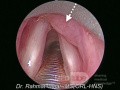 Larynx-Lymphom
