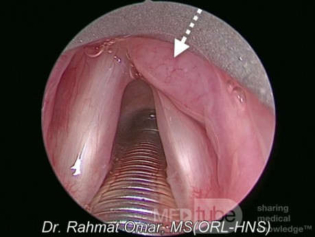 Larynx-Lymphom