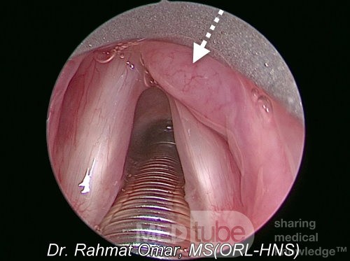 Larynx-Lymphom