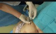 Behandlung von symptomatischen postoperativen Lymphzysten
