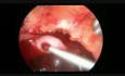 Laparoskopische Salpingektomie zur Behandlung der Extrauteringravidität mit Hämatoperitoneu m
