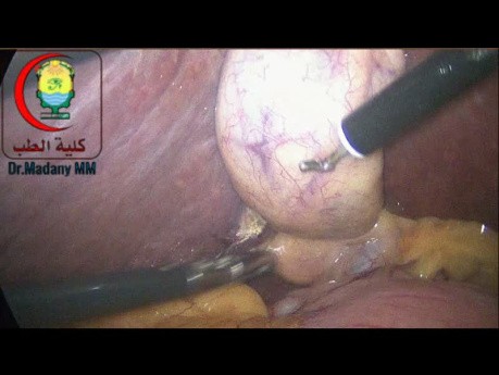 Beträchtliche Lymphknoten im Porta Hepatis.