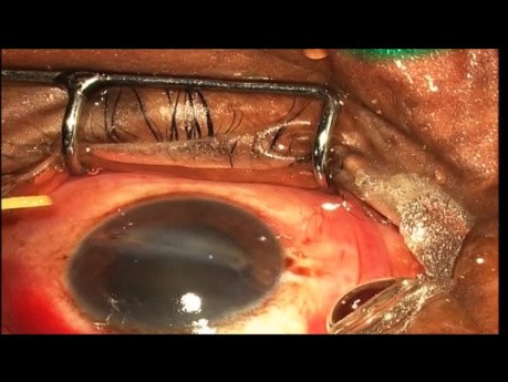 Entfernung mehrerer Fremdkörper aus einem Auge mit erfolgreicher visueller Wiederherstellung