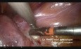 Totale laparoskopische Hysterektomie (ein eingefrorenes Becken)
