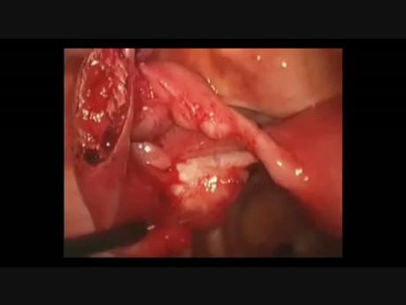 Eileiterschwangerschaft- Salpingostomie