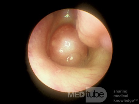 Choanalpolyp