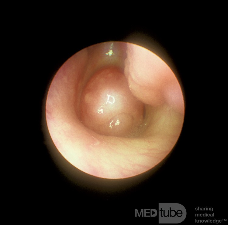 Choanalpolyp
