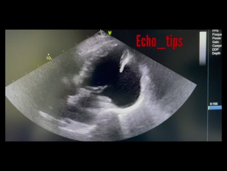 Kardiologie in der Praxis – Was sehen Sie in der Echokardiographie?