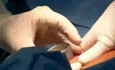 Augmentation der Brüste - Silikonprothese