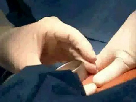 Augmentation der Brüste - Silikonprothese