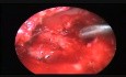 Endoskopische Tympanomastoidektomie mit Weichteilrekonstruktion