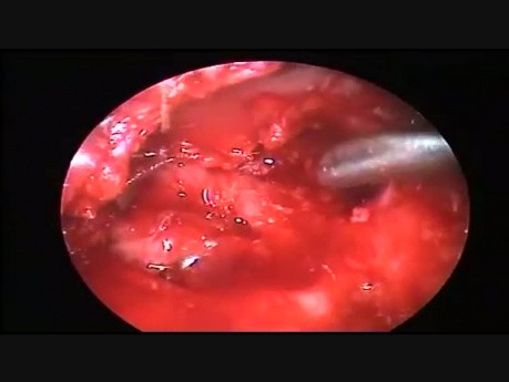 Endoskopische Tympanomastoidektomie mit Weichteilrekonstruktion