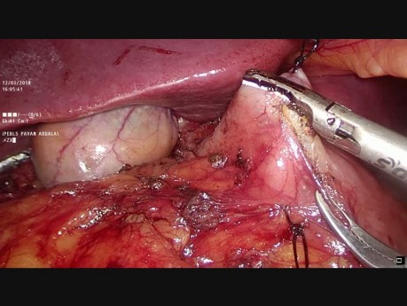 Laparoskopische Zwölffingerdarm-Operation von Neuroendokrine Tumoren