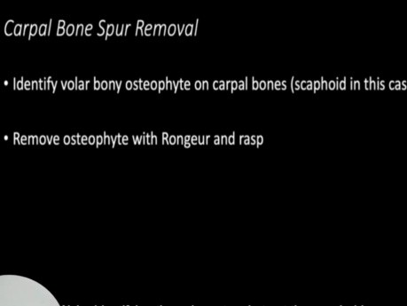 Ruptur der Flexor Pollicis Longus-Sehne (Mannerfelt-Syndrom): Bewertung und chirurgische Behandlung