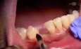 Ersatz einer fehlgeschlagenen Implantatbrücke