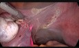 Totale laparoskopische Hysterektomie mit Ureter Stenting