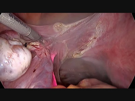 Totale laparoskopische Hysterektomie mit Ureter Stenting