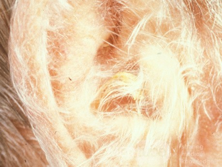 Hypertrichosis lanuginosa acquisita