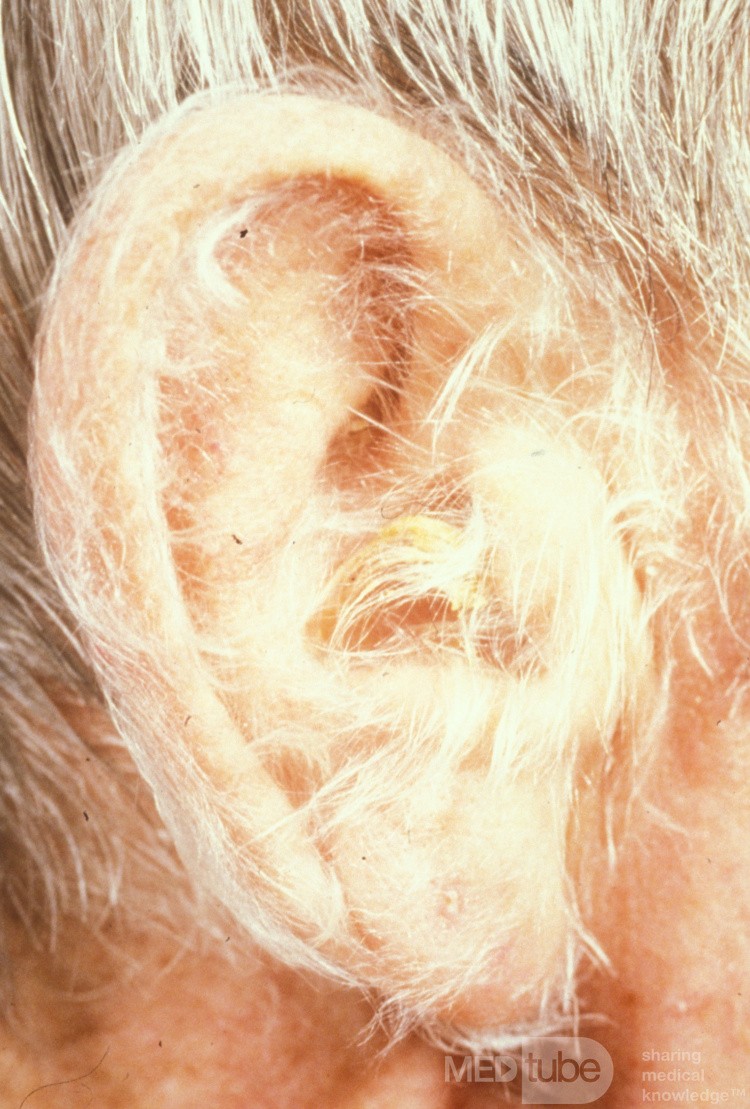 Hypertrichosis lanuginosa acquisita