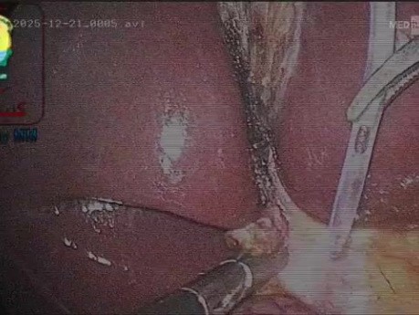 Ist es gerechtfertigt, das terminale Ende des Ductus cysticus auf diese Weise zu dissezieren?