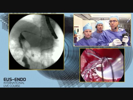Entfernung von FCSEMS und Plastikstent-Implantation zur Kalibrierung der Anastomose