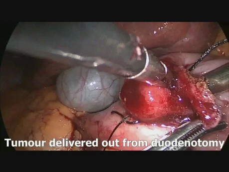 Laparoskopische wegen Duodenum Resektion von neuroendokrinen Zwölffingerdarmkrebs