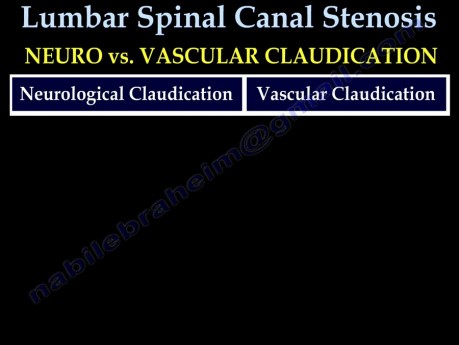 Rückenschmerzen - Spinalkanalstenose der Lendenwirbelsäule - Video-Vorlesung