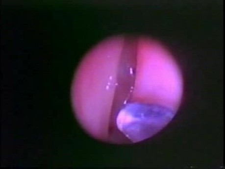 Funktionelle endoskopische Nasennebenhöhlenchirurgie (FESS) - Anatomische Demonstration - Teil 1 von 5