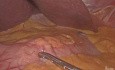 Laparoskopische subtotale Gastrektomie mit D1-Lymphadenektomie