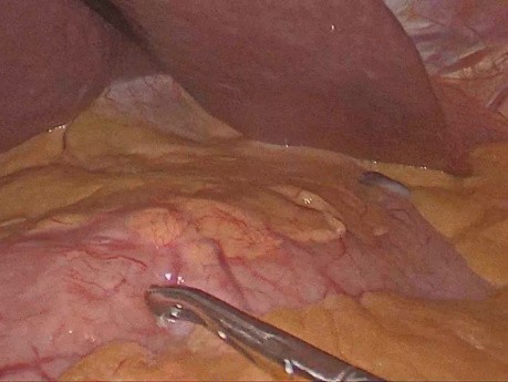 Laparoskopische subtotale Gastrektomie mit D1-Lymphadenektomie
