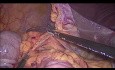 Laparoskopische Hemikolektomie rechts mit intraabdomineller Anastomose