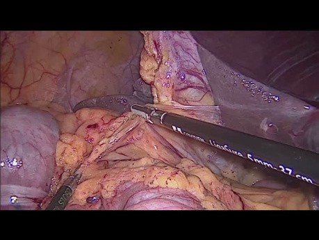 Laparoskopische Hemikolektomie rechts mit intraabdomineller Anastomose