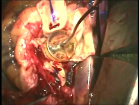 Wie soll das Auswechseln der Aorta-Wurzel durchgeführt werden