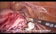 Goels Technik der laparoskopischen Hysterektomie bei Endometriumkarzinom
