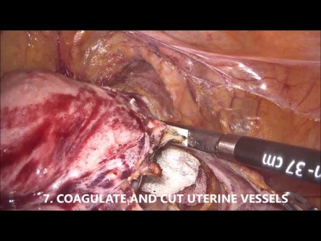 Goels Technik der laparoskopischen Hysterektomie bei Endometriumkarzinom