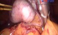 Totale laparoskopische Hysterektomie bei fortgeschrittener Endometriose