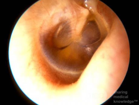 Seröse Otitis media - Mittelohrerguss
