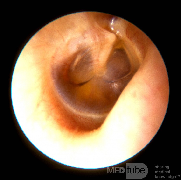 Seröse Otitis media - Mittelohrerguss
