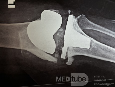 Aseptische Lockerung mit Degeneration des distalen Femurs