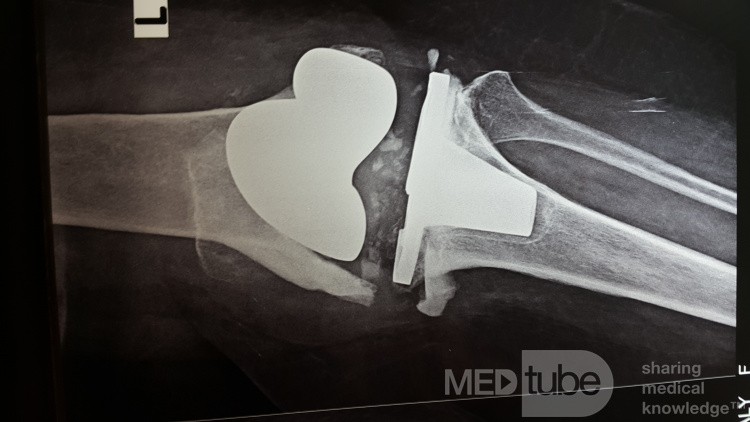Aseptische Lockerung mit Degeneration des distalen Femurs