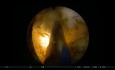 GreenLight-Photoverdampfung der Prostata - ejakulationsschonende Verfahren