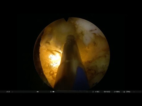 GreenLight-Photoverdampfung der Prostata - ejakulationsschonende Verfahren