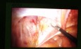 Laparoskopische Leistenhernienreparation, TAPP
