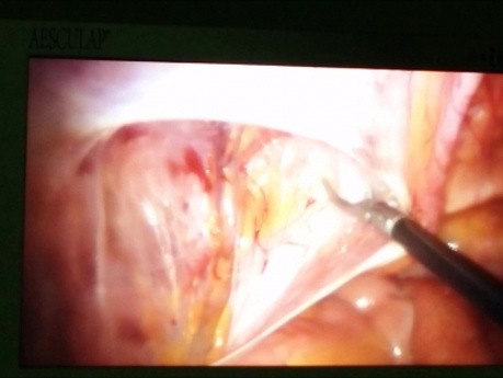 Laparoskopische Leistenhernienreparation, TAPP